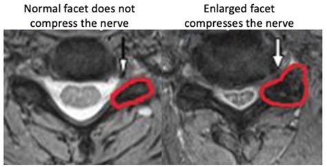 cervical spine mri results interpretation|Cervical MRI scan .